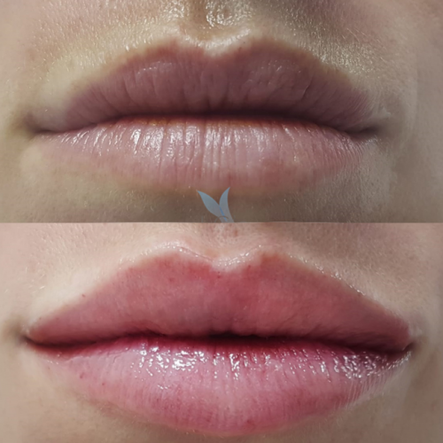 Aumento de labios